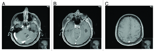 Figure 8. MRI of the brain done on 5/11/2012. Cystic lesions were seen in the cerebellum (A), temporal (B), and frontal (C) lobes. Resection of the two large lesions showed no viable tumor on pathology specimens. PET scan done around the same time showed return of the lung lesions to baseline suggesting maximal response in the lung and possibly in the brain, which might explain the absence of viable tumor on pathology.
