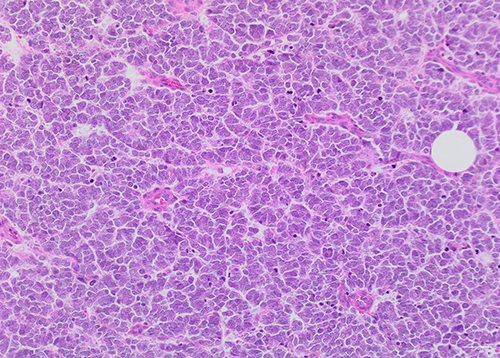 Figure 2 Higher magnification of the tumor cells highlights the cytologic features of enlarged nuclei, nuclear molding, and scant cytoplasm. Numerous mitotic figures and apoptotic cells are seen. (Hematoxylin-eosin, original magnification x20).