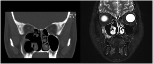 Figure 6. The CT examination of the paranasal sinuses was repeated 3 months after surgery, showing enlargement of the right maxillary sinus cavity, thinning of the sinus wall, and absence of the medial wall part and middle turbinate, showing postoperative changes; no obstruction or narrowing of the nasal cavity was seen now. No recurrence was found in the paranasal sinus MRI at 9 months after surgery.