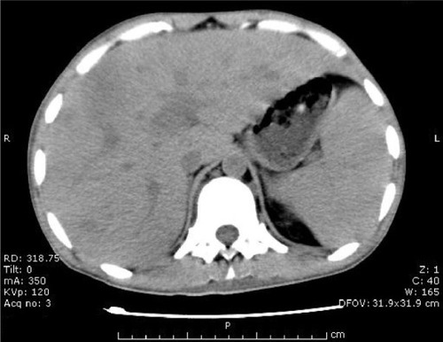 Figure 1 Abdominopelvic computed tomography.