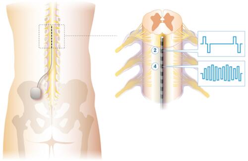 Figure 1 An implanted spinal cord stimulation system with a lead positioned in the epidural space is used to deliver multiplexed stimulation patterns (a fixed amplitude, low frequency program and a variable amplitude, high frequency program) to differential targets (electrodes 2 and 4) on the dorsal columns of the spinal cord.