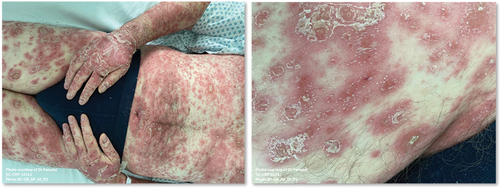 Figure 2. Sudden withdrawal of corticosteroids and other systemic therapies triggering GPP flares. A 52-year-old man with long-standing, ongoing psoriasis stopped retinoid treatment and started to apply topical corticosteroids periodically without consulting his clinician. The patient was admitted to hospital at the onset of a GPP flare. (images provided with permission, courtesy of Professor Aikaterini Patsatsi (Aristotle University School of Medicine, Thessaloniki, Greece).
