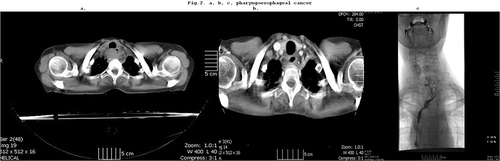 Figure 2 (a) T4 pharyngo-esophageal junction cancer shown by CT. (b) CT after preoperative chemoradiation, shows complete clinical response. (c) Pharyngo-jejuno-esophagostomy (histology: pCR, T0N0).