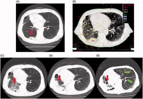 Figure 2. Disease course of the patient with grade 5 pulmonary fibrosis. (A) Computed tomography (CT) before stereotactic body radiotherapy (SBRT) revealed a mass in the right lower lobe (red arrow). (B) Treatment planning for SBRT (50 Gy in five fractions). (C) CT findings 3 months after SBRT revealed that the tumor decreased in size (red arrow) and a frosted glassy shadow appeared. (D) CT findings 1 year and 1 month after SBRT; the lung volume had severely contracted in the region of the irradiated field (red arrow). (E) CT findings 2 years and 4 months after SBRT. An interstitial pneumonitis-like pattern was observed bilaterally in the pulmonary region outside the irradiated field (red arrows), and honeycomb lung in the peripheral area was observed (green arrows).