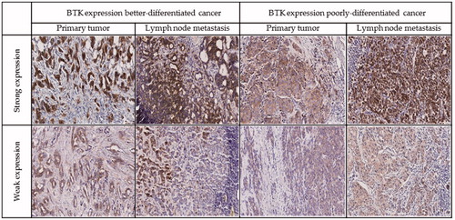 Figure 5. Representative examples of immunohistochemistry for BTK expression in breast cancer cells.