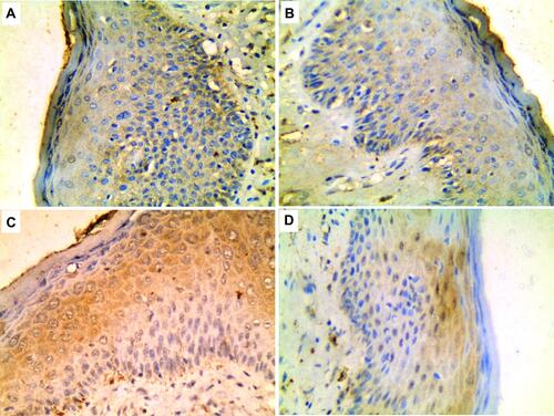 Figure 1 Mild positive membrano-cytoplasmic expression of TROP2 in epidermis of; (A) normal control and (B) BCC peri-lesional tissue. Moderate positive cytoplasmic expression of TROP2 in epidermis of; (C) BCC and (D) SCC (Immunoperoxidase x400 for all).