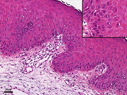 Figure 2 Skin biopsy histopathology. Karyopyknosis was observed in keratinocytes, indicating an early stage of irreversible necrosis or apoptosis of cells. Lymphocyte infiltration and vessel edema appeared in the dermo-epidermal junction.