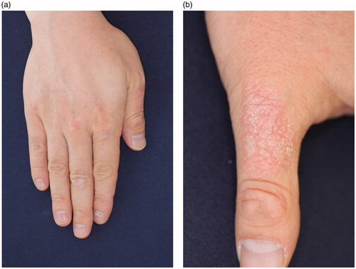 Figure 1. (a,b) Photo of the patient skin was taken in 2012.