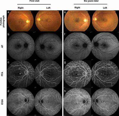 Figure 1. Multimodal imaging of PDSFF at first visit and after six years. (a) Fundus photograph showed multiple yellow flecks in the macula extending beyond the vascular arcades in both eyes. (b) AF showed hyperautofluorescence with adjacent zones of hypoautofluorescence. (c) FFA showed small areas of hyperfluorescent flecks bilaterally, and unilateral leakage suggesting CNV in the right eye. (d) ICGA showed hypofluorescent flecks bilaterally, and abnormal submacular choroidal vascular network with leakage in the right eye. (e) Fundus photograph showed increased number of yellow flecks bilaterally and regression of the foveal lesion without hemorrhage in the right eye. (f) AF showed confluence of the flecks, and granular zones of hypoautofluorescence within the area of hyperautofluorescence. (g) FFA showed increased number of hyperfluorescent flecks bilaterally without leakage. (h) ICGA showed abnormal choroidal vascular network without leakage