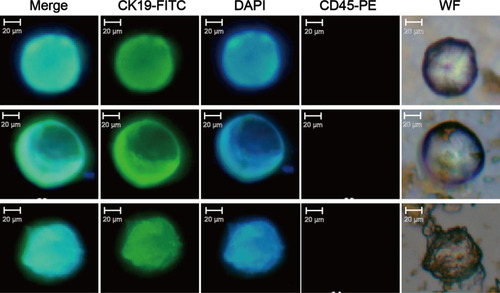 Figure 5 CTC immunofluorescence identification results of CRC patients captured by K-LMB.