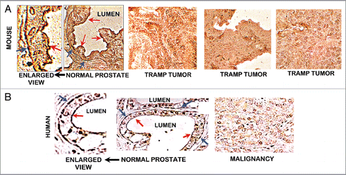 Figure 5 (A) ZIP1 transporter in normal mouse prostate and TRAMP tumors. ZIP1 IHC reveals the presence of the transporter in normal prostate acinus. The transporter is localized at the glandular epithelium basal membrane (blue arrows), and at the apical membrane (red arrows). There is no detectable transporter in the TRAMP tumors. (B) ZIP1 transporter in human prostate (taken from Franklin et al.Citation10). Shows same ZIP1 relationship as in (A).