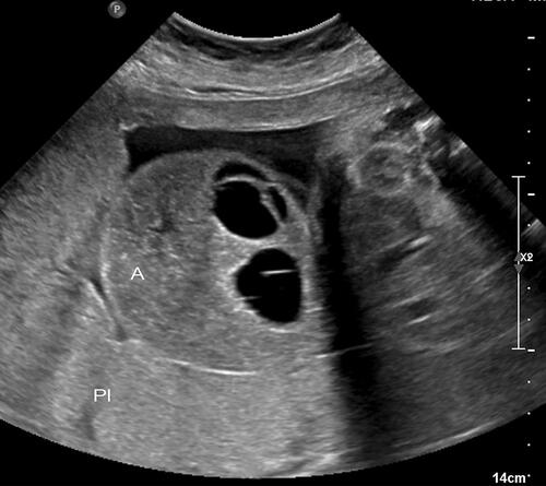 Figure 2 Absent umbilical cord in a (twin reverse arterial perfusion TRAP) twin embedded within the placenta. Note the absence of an umbilical cord to this fetus.