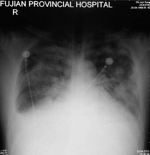 Figure 3. Bedside chest X-ray showing acute pulmonary edema: enlarged heart size and apical vascular redistribution and small bilateral pleural effusions.