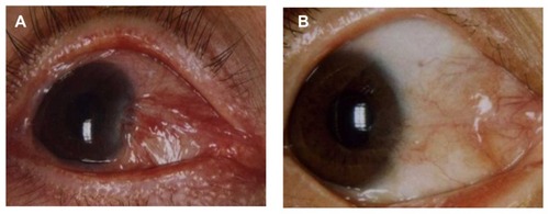 Figure 2 Recurrent pterygia after surgical excision with antimetabolite application (A) received 5-fluorouracil and (B) received mitomycin C.