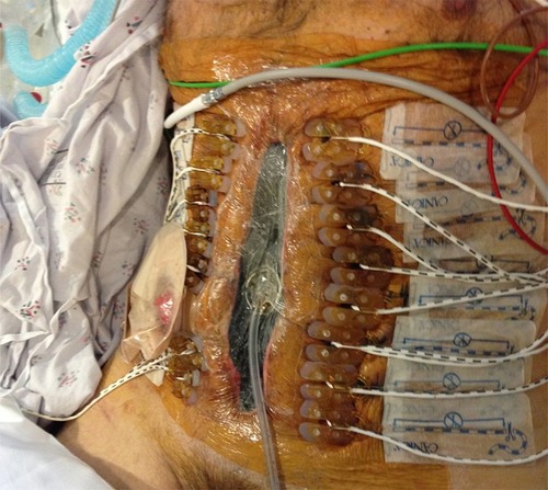 Figure 4 A clinical image of a patient with peritonitis and abdominal compartment syndrome subjected to fascial closure with negative pressure wound dressing and the ABRA system (Dynamic tissue systems, Barrie, Ontario, Canada). 