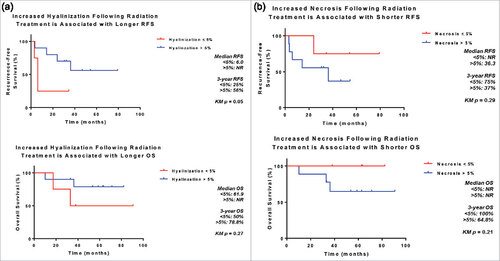 Figure 2. Association between treatment effect following radiotherapy and survival. Increased hyalinization (A) and decreased necrosis (B) of undifferentiated pleomorphic sarcomas following radiotherapy are associated with improved recurrence-free and overall survival following surgical resection.
