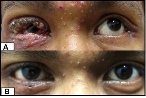 Figure 2 (A) One-week follow up after topical therapy with 20% KOH solution, (B) resolution of the lesions at 4 weeks after therapy.