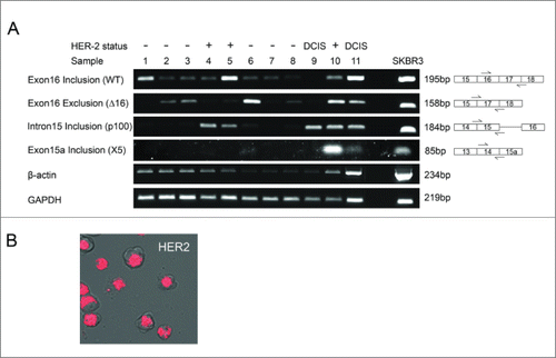 Figure 2. HER2 mRNA expression in breast tumor tissue and SKBR3 breast cancer cells. (A) HER2 mRNA expression was investigated in a cohort of 12 breast tumor tissue samples and the HER2 positive SKBR3 breast cancer cell line. Splice-specific primers for exon16 inclusion (WT), exon16 exclusion (Δ16HER2), intron 15 inclusion (p100) and exon 15a inclusion (X5) were used to determine expression of HER2 splice variants along with 2 housekeeping genes GAPDH and β-actin. (B) Intracellular expression of WT HER2 mRNA in live SKBR3 breast cancer cells using SmartFlare™ RNA detection probes.