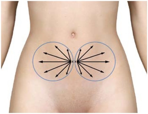 Figure 10 Example marking of lower abdomen site for harvesting of subdermal adipose tissue.