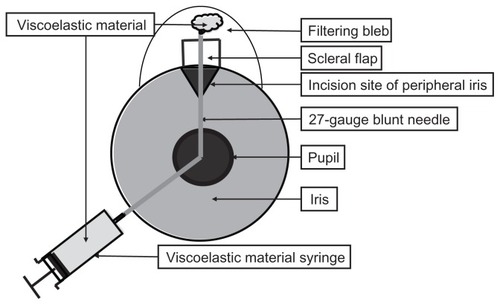 Figure 1 The schema of the blunt needle revision via the anterior chamber to treat failed filtering blebs.