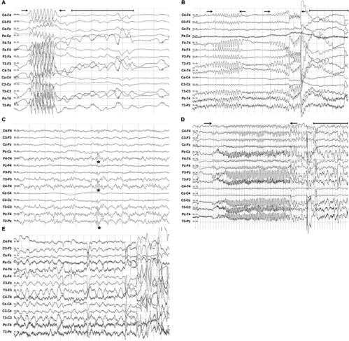 Figure 6. EEG recordings showing pathological activity in horses. (a) Generalised spike burst activity of 4–5 Hz and <520 μV amplitude indicative of interictal epileptiform activity in a patient with clinical epilepsy (patient 7). Scale: amplitude 200 μV/division and 1 second/division. (b) Intermittent rhythmical delta activity of 3–4 Hz (duration 3 seconds) followed by generalised large irregular and uncoordinated activity (patient 10). Scale: amplitude 50 μV/cm and 1 second/division. (c) Spikes located on F4-T4, C4-T4, P4-T4 and Tz-Pz (patient 3) identified as sharp waves (amplitude 20–120 μV and duration 80 ms). Scale: amplitude 50 μV, 1 second/division. (d) Generalised high-voltage rhythmical spike discharge (patient 9) (amplitude 600–800 μV and frequency 3–4 Hz lasting 31 seconds with chaotic extinction). Scale: amplitude 200 μV/division and 1 second/division. (e) Intermittent generalised rhythmical slow delta waves of 1 Hz (amplitude of 20–100 μV and 14 seconds duration with chaotic extinction) (patient 10). Scale: amplitude 50 μV/division and 10 seconds/division.