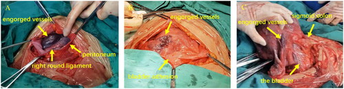 Figure 1. The pelvic adhesions on the anterior uterine wall and engorged vessels on the right uterine horn.