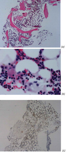 Figure 2. Bone marrow biopsy slides, demonstrating near absence of erythroid elements. (a) Low-power view of a HE-stained section (x20). (b) High-power view of a HE-stained section (x400). (c) Low-power view of a CD71 stain for confirmation of pure red cell aplasia.