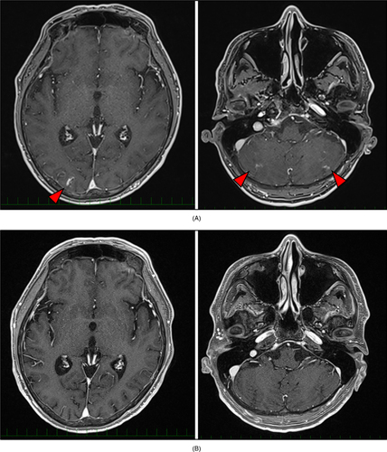 Figure 1. Contrast-enhanced magnetic resonance images of the head. (A) Brain metastasis in the right occipital lobe and leptomeningeal disease along the cerebellar sulci. (B) Disappearance of brain metastasis and leptomeningeal disease.The red arrows indicate the metastatic areas.