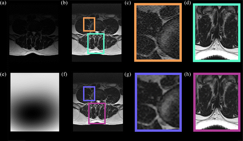 Figure 6 The original MR image (a) and compliment of the extracted bias field (e). Shown are the unbiased image corrected with just LEMS (b) and the same unbiased image filtered with (f). Zoomed regions of the unbiased image are shown in (c) and (d), while (g) and (h) are the same zoomed regions for . Greater filtering was observed at (g) relative to (c), while less filtering occurred at (h) relative to (d).