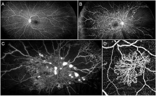 Figure 1. Angiographic findings in different stages of diabetic retinopathy. (A) Mild form of NPDR characterised by preserved posterior pole and minor capillary non-perfusion changes detected in the extreme periphery. (B) Advanced form of NPDR, showing extensive peripheral capillary non-perfusion and central involvement with several microaneurysms and macular edoema. (C) A case of PDR with extensive peripheral capillary non-perfusion and neovascularizations detected both at the level of the optic nerve head and the retinal periphery. (D) Optical coherence tomography angiography reconstruction of a PDR-related neovascularization.