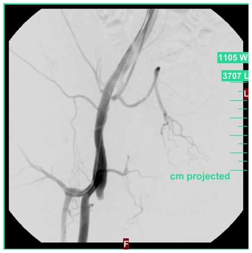 Figure 3 Acute proximal occlusion of a femoro-popliteal bypass on right.