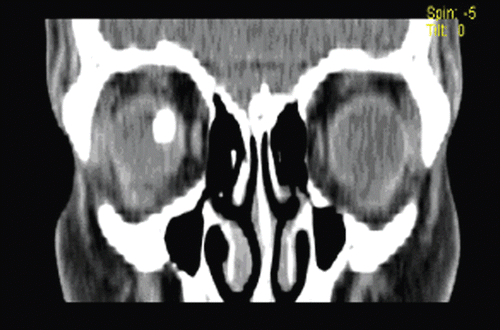 FIGURE 6  Orbital CT Scan - Posterior Granuloma.