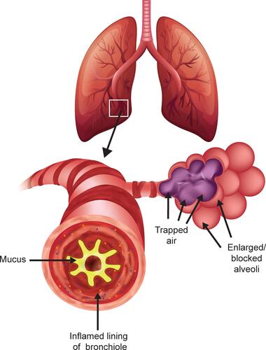 Figure 1 Pathophysiology of chronic obstructive pulmonary disease. During the time course of COPD, inflammation of the airways can lead to thickening of the airway walls, increased mucus production, and damage to alveoli and alveolar ducts that leads to enlargement of the air spaces/emphysema, and potentially to air-trapping.Citation11