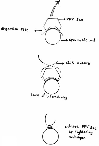 Figure 1 Schematic cross-section view of the spermatic cord and PPV sac in PVST technique.