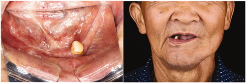 Figure 7. Intra-oral and extra-oral photographs (taken after 12 months post-operatively).