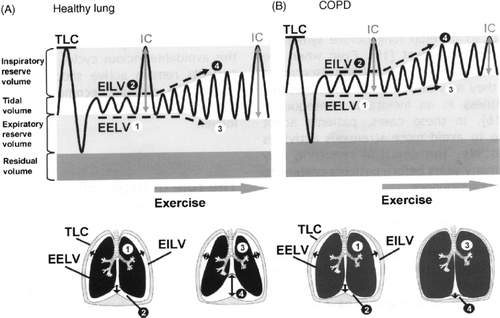 Figure 6 The change in lung volumes during exercise in healthy lungs (A) and COPD (B). TLC, total lung capacity; IC, inspiratory capacity; EELV, end-expiratory lung volume; EILV, end-inspiratory lung volume.