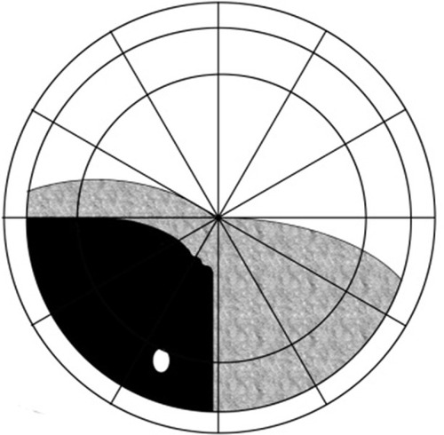 Figure 3 Group 2: shallow detachments that occurred in the inferior region.