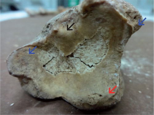 Figure 3. Left tibia: distal articular surface with articular osteophyte (black arrow), marginal osteophytes (blue arrows), and articular surface erosions (red arrow).