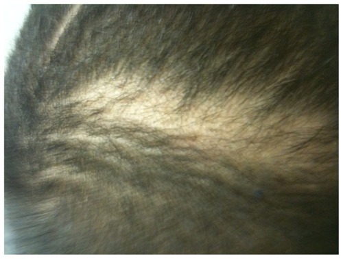 Figure 3 Patient’s mother reported no further improvement in alopecia after 12 weeks of griseofulvin.