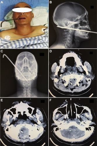 Figure 1 Preoperative images (A–D) showing the iron rod both in the patient and on imaging studies. (E and F) are postoperative CT scan images.