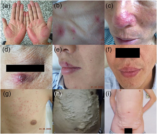 Figure 1. Vascular alterations in patients with chronic liver disease. (a) Palmar erythema, (b, c) Spider angioma, (d) Arteriovenous haemangioma, (e, f) arteriovenous haemangioma on the upper lip of a 38-year-old cirrhotic male with HBV infection, with remission after 10 years of antiviral treatment. (g) Paper money skin, (h) caput medusa, (i) abdominal varicose veins in inferior vena cava obstruction syndrome.