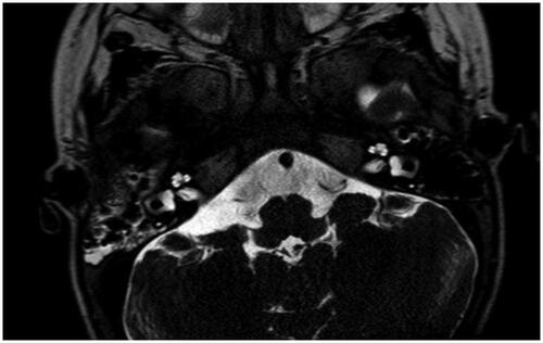 Figure 3. Magnetic resonance imaging of a case with bilateral vestibulocochlear nerve aplasia and normal inner ear anatomy, Casselman grade 2B.