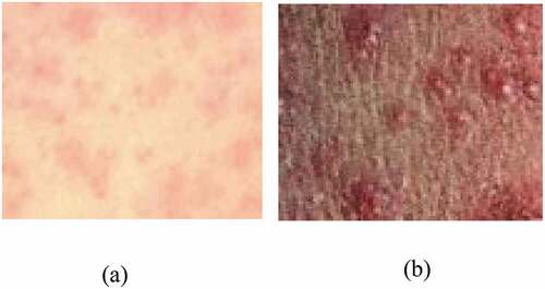 Figure 1. Skin rash images (a) Maculopapular rash, (b) Vesicular rash.