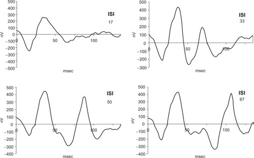 Figure 1 Summed responses for multifocal electroretinographic recordings with twin-flash application showing amplitude recovery of the second flash with increasing ISIs of 17, 33, 50, and 67 msec.