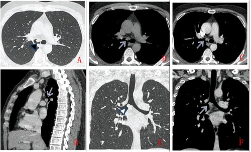 Figure 2. A 36-year-old man, with no clinical symptoms, chest CT scan without contrast (A.axial lung window, B.axial mediastinum window) and with contrast (C.axial, D. Sagittal, E.coronal lung window, F. coronal mediastinum window). A solid nodule in right main bronchus (as indicated by arrow), with smooth margin,uniform density, moderate enhancement. Pathologically confirmed low-grade PMEC after surgical operation.
