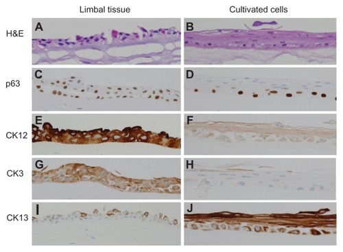 Figure 1 Histopathologic analysis of limbal tissue (left column) compared with cultivated corneal epithelial cells (right column). Hematoxylin-eosin staining of the limbal tissue (A) and cultivated epithelial cells (B) show a stratified epithelium consisting of two to four layers resting on an AM. Expression of p63 is positive, based on immunostaining of limbal tissue (C) and cultivated epithelial cells (D), which indicates the cellular property of the corneal epithelial stem’s cultivated epithelial sheet. CK3 and CK12 indicate the corneal epithelial phenotype is in the limbal tissue (E and G) and cultivated epithelial (F and H) cells. CK13 is in both limbal tissue (I) and cultivated epithelial cells (J), indicating a nonkeratinized epithelial characteristic.