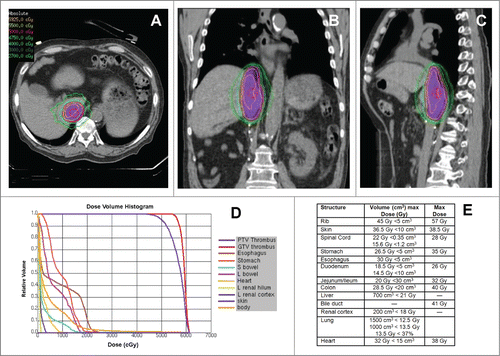 Figure 2. SABR Treatment of Recurrent IVC-TT. (A-C) Representative axial, sagittal, and coronal images of the SABR treatment plan with isodose lines showing dose distribution and coverage of the IVC-TT. Patient was immobilized with a vacuum bag in an Elekta body frame. Abdominal compression and 4D-CT with contrast was used for respiratory motion management and assessment respectively. Treatment planning MRI was fused for target delineation. The dose was prescribed to the 84% isodose line via 11 non-coplanar photon beams of 10 MV and 3D optimization ensuring >95% PTV coverage with a 0.5 cm margin on the TT. (D) Radiation dose volume histogram from SABR plan of 50 Gy in 5 fractions showing optimized doses to critical organs as well as target volume (PTV). (E) Radiation dose constraints used for treatment planning.