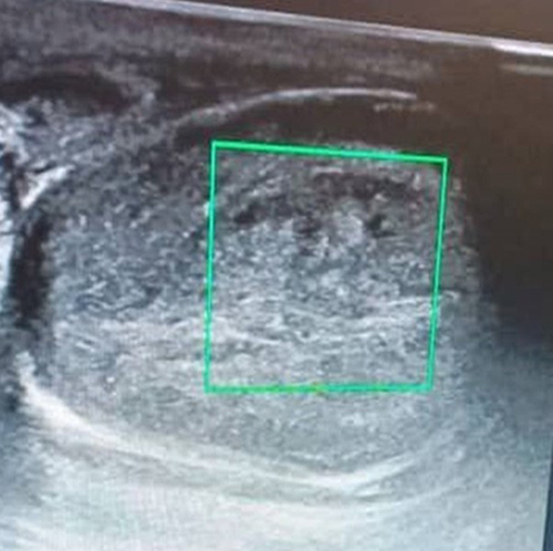 Figure 1 Scrotal Doppler ultrasound showing left testicular infarction with heterogeneous parenchyma and areas of hypoechoic and hyper-echoic changes with no color Doppler flow detected over testicular parenchyma. Diffusely enlarged testicle measuring 4.7×3.2 cm in size. Otherwise, no hydrocele, epididymal, or spermatic chord enlargement noted with normal studies on contralateral testicle.