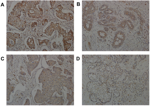 Figure 2 Representative micrographs of immunohistochemical stains showing Aurora A expression high staining (A), Aurora A expression median staining (B), Aurora A expression weak staining (C), Aurora A expression negative (D).