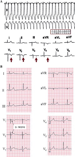 Figure 4. Arrhythmogenic right ventricular dysplasia. A: ECG on top presents ventricular tachycardia with left bundle branch block QRS morphology, and ECG below taken from the same patient demonstrates T wave inversions in the right precordial leads (V1–3), characteristic of ARVD. Paper speed 25 mm/s, gain 10 mm/mV. B: ECG presents a subtle epsilon wave in leads V1–3 without T wave inversions. Paper speed 25 mm/s, gain 10 mm/mV.